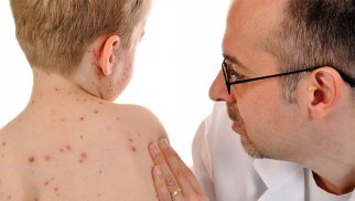 Səhiyyə Nazirliyi 10 yaşa qədər uşaqların qızılcaya qarşı vaksinasiyasına çağırış edir