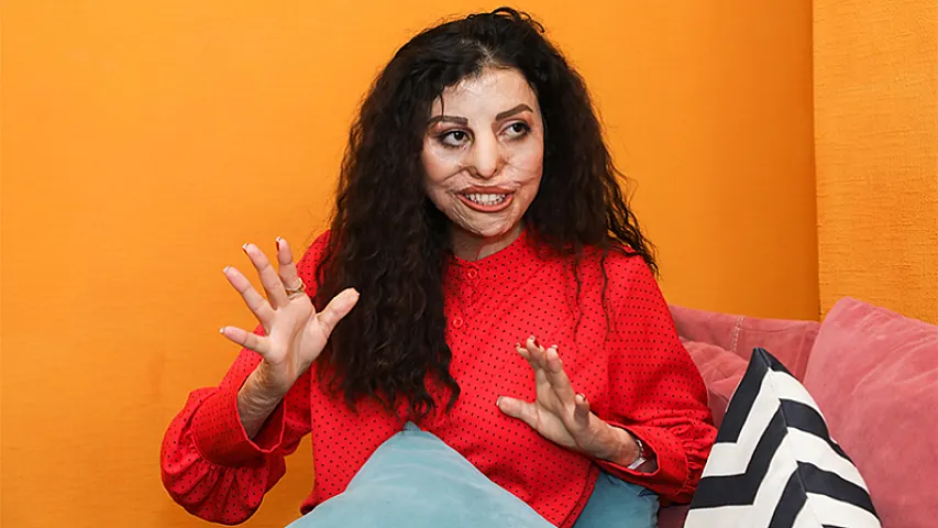 7 yaşında partlayış, 7 gün komada qalmaq, 20 illik mübarizə - Proqramçı qızın hekayəsi